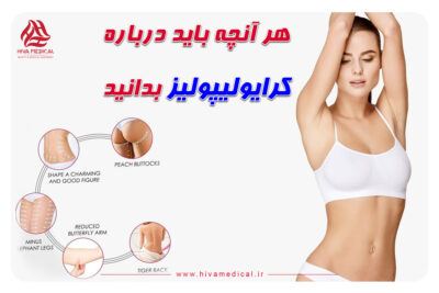 کرایولیپولیز